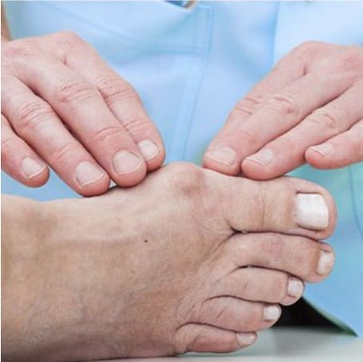Bunions can be painful and cause secondary problems such as hammer-toe, corns and calluses. Your Podiatrist can provide effective treatment to ease discomfort. The House Clinics, Bristol.