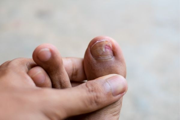 Damaged and painful toenails can be treated by a podiatrist at The House Clinics, Bristol