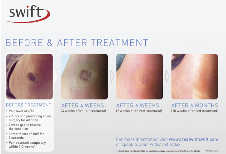 Swift Treatment - Breakthrough Treatment Now Available For Stubborn Verruca | The House Clinics