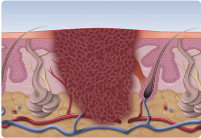 Swift Treatment - Breakthrough Treatment Now Available For Stubborn Verruca | The House Clinics