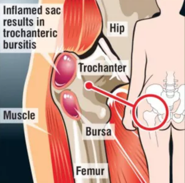 Hip Bursitis  Symptoms, Treatments, & Prevention
