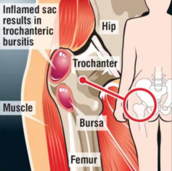 Hip Pain Location Diagram