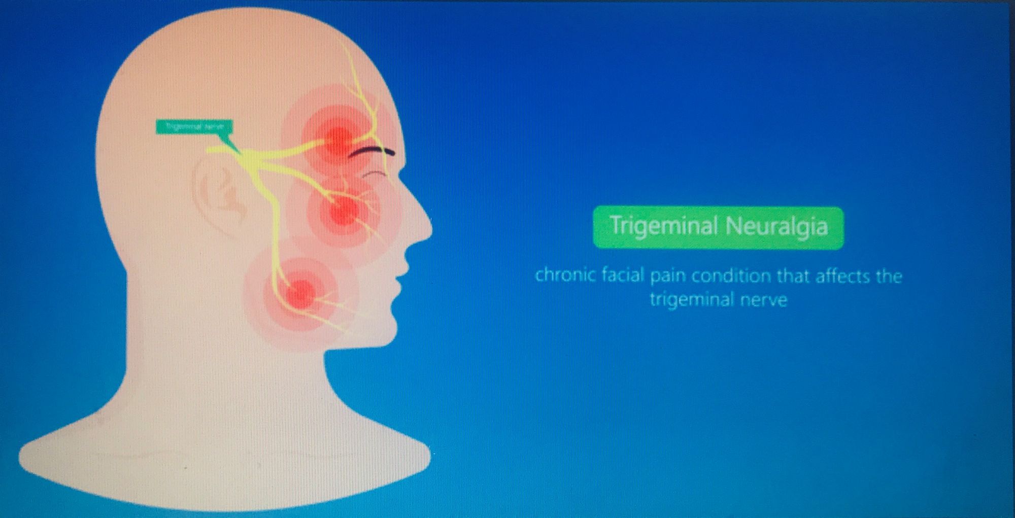 Chiropractic Treatment for Trigeminal Neuralgia, The House Clinics, Bristol