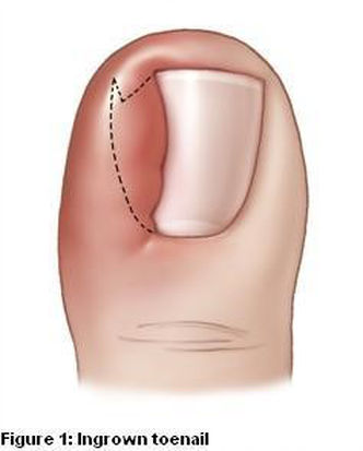 Ingrown Toenails are a common condition we treat at The House Clinics, Bristol Podiatry